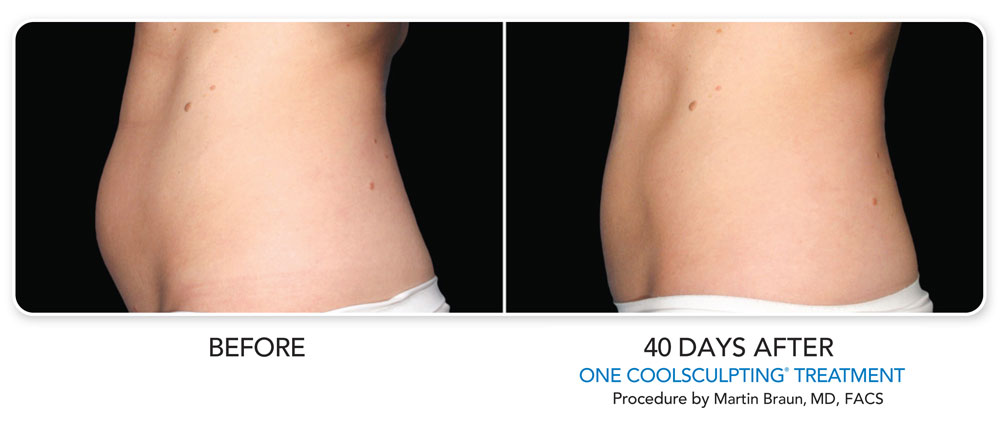 Coolsculpting Before and After Photo Results 40 Days After First Procedure