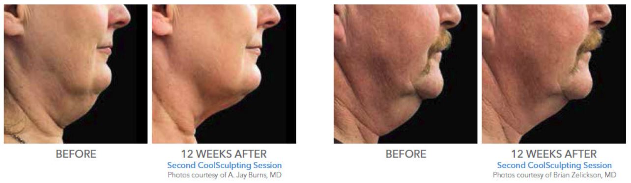 Coolsculpting Before and After Photo Results 12 Weeks After Second Procedure