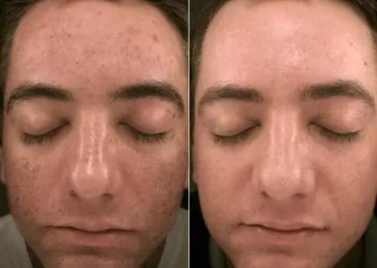 v-facial