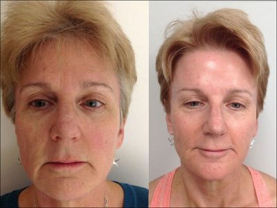 Before and After Vampire Facial Procedure